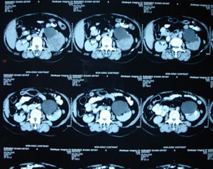 Renal cell carcinoma