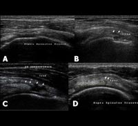 Supraspinatus tear