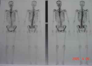 Nuclear Scan