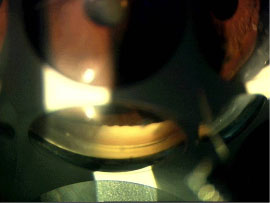 Closed angle on gonioscopy