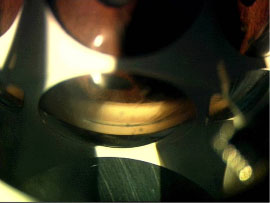 Closed angle on gonioscopy