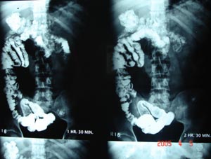 Barium x ray
