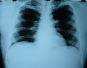 Chest X-ray PA view