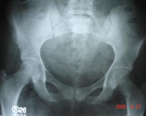 Colrtical fracture