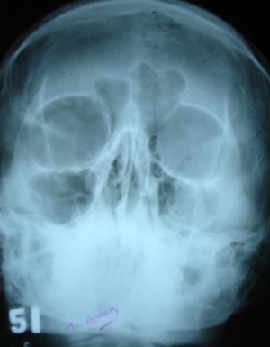 Maxillary sinusitis