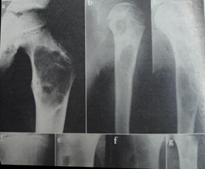 Osteoclastoma