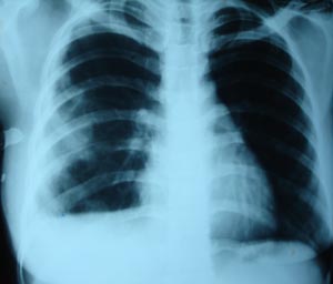 Pleural effusion1
