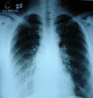 Right  lower zone opacity 2