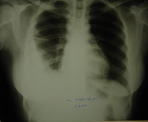 Right lower zone pleural effusion