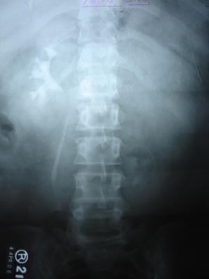 Single Kidney