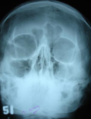 Sinusitis